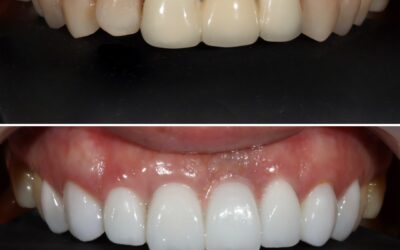 Pros and Cons of Porcelain Veneers